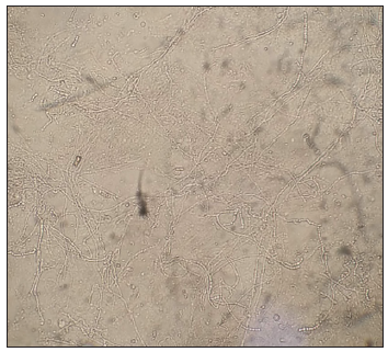 KOH mount from the periphery showed branching mycelial elements (40x) (KOH: Potassium hydroxide).